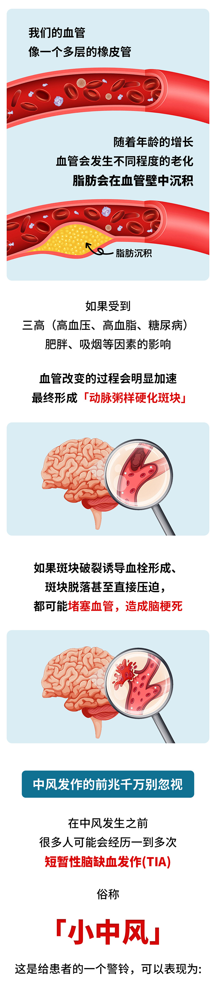 中風(fēng)的5個(gè)前兆，盡早發(fā)現(xiàn)能救命_02.jpg